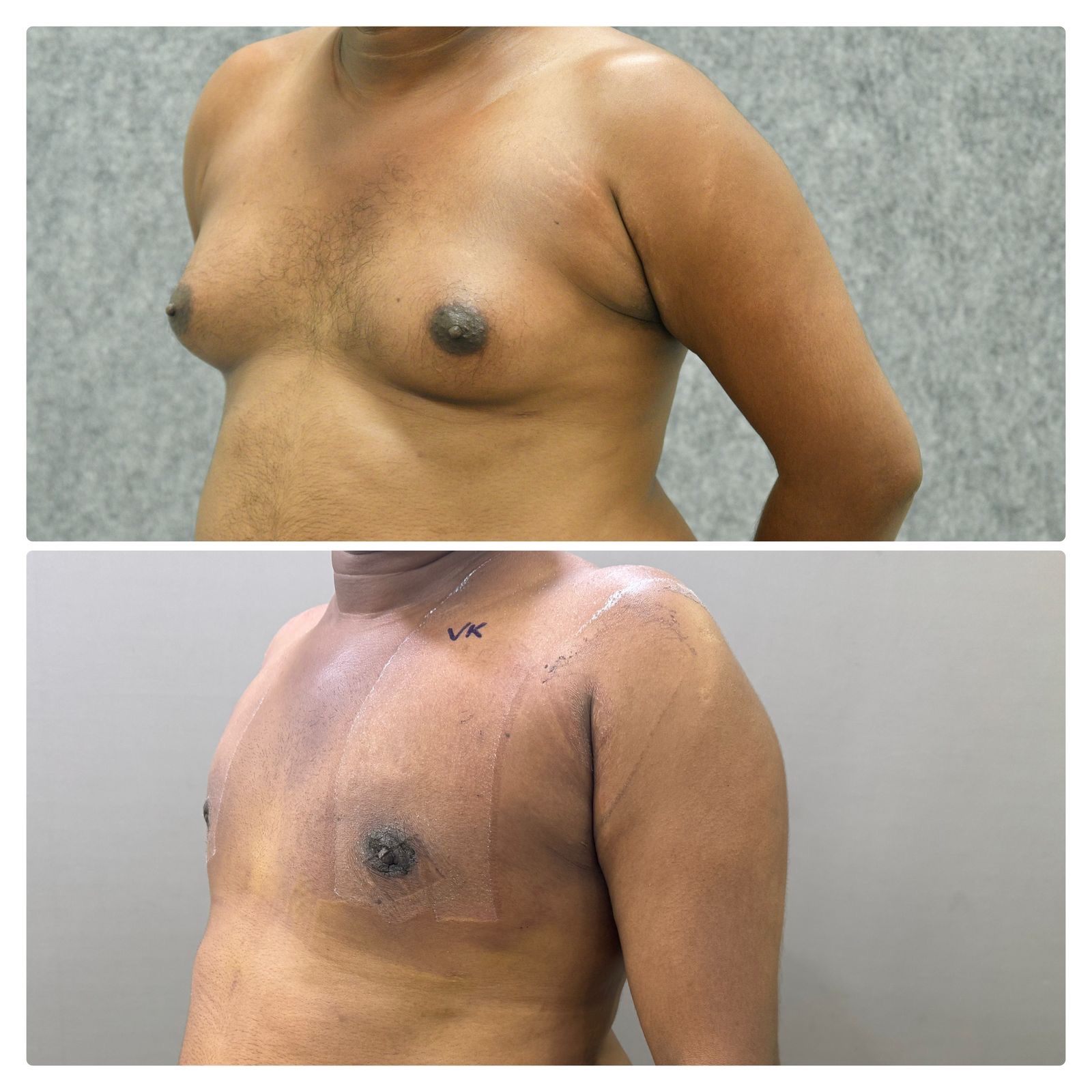 Surgery Gives best results even in higher grade Gynecomastia 