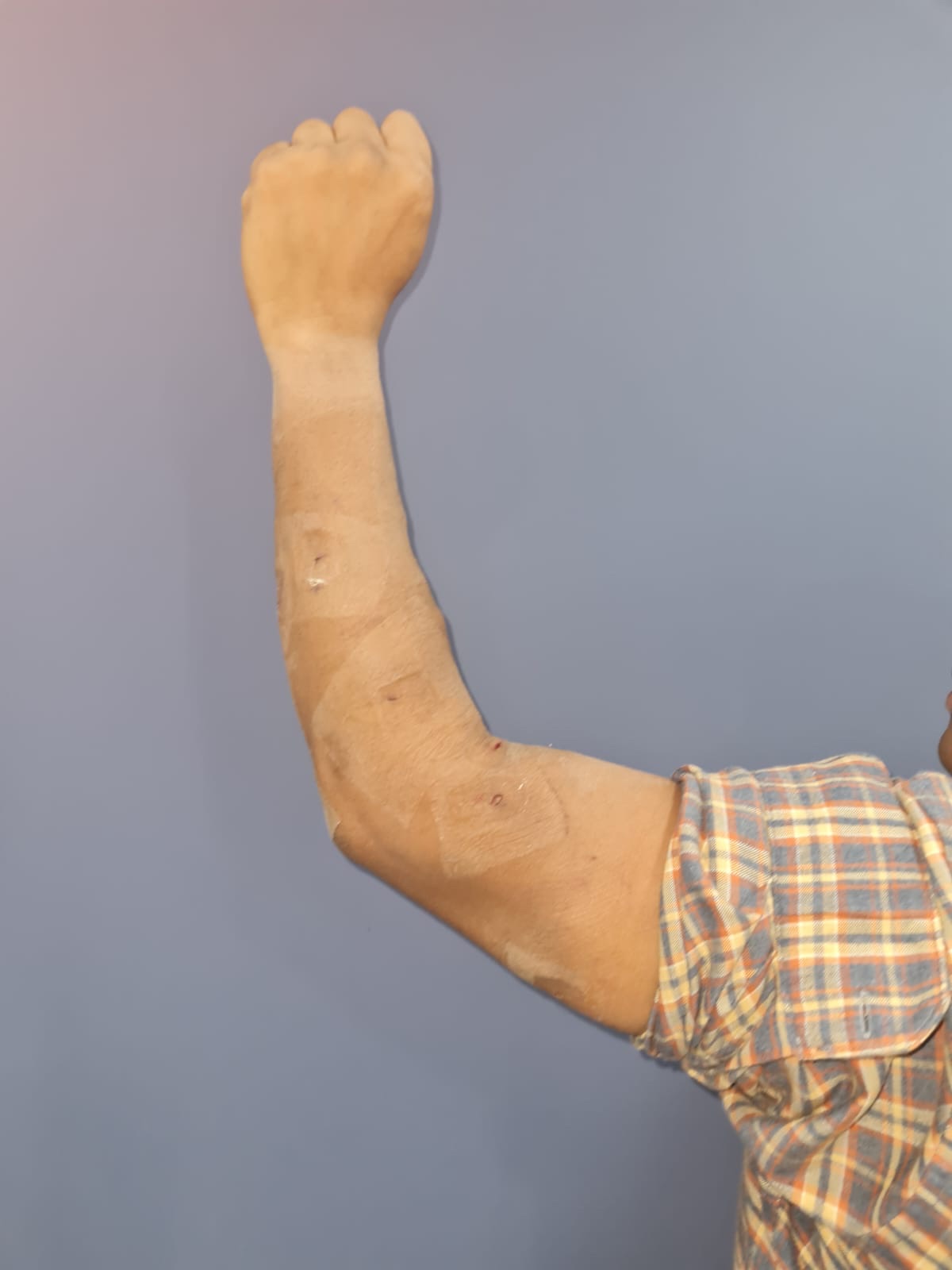 See the results of plastic surgery with almost no scars after 54 lipoma excision 