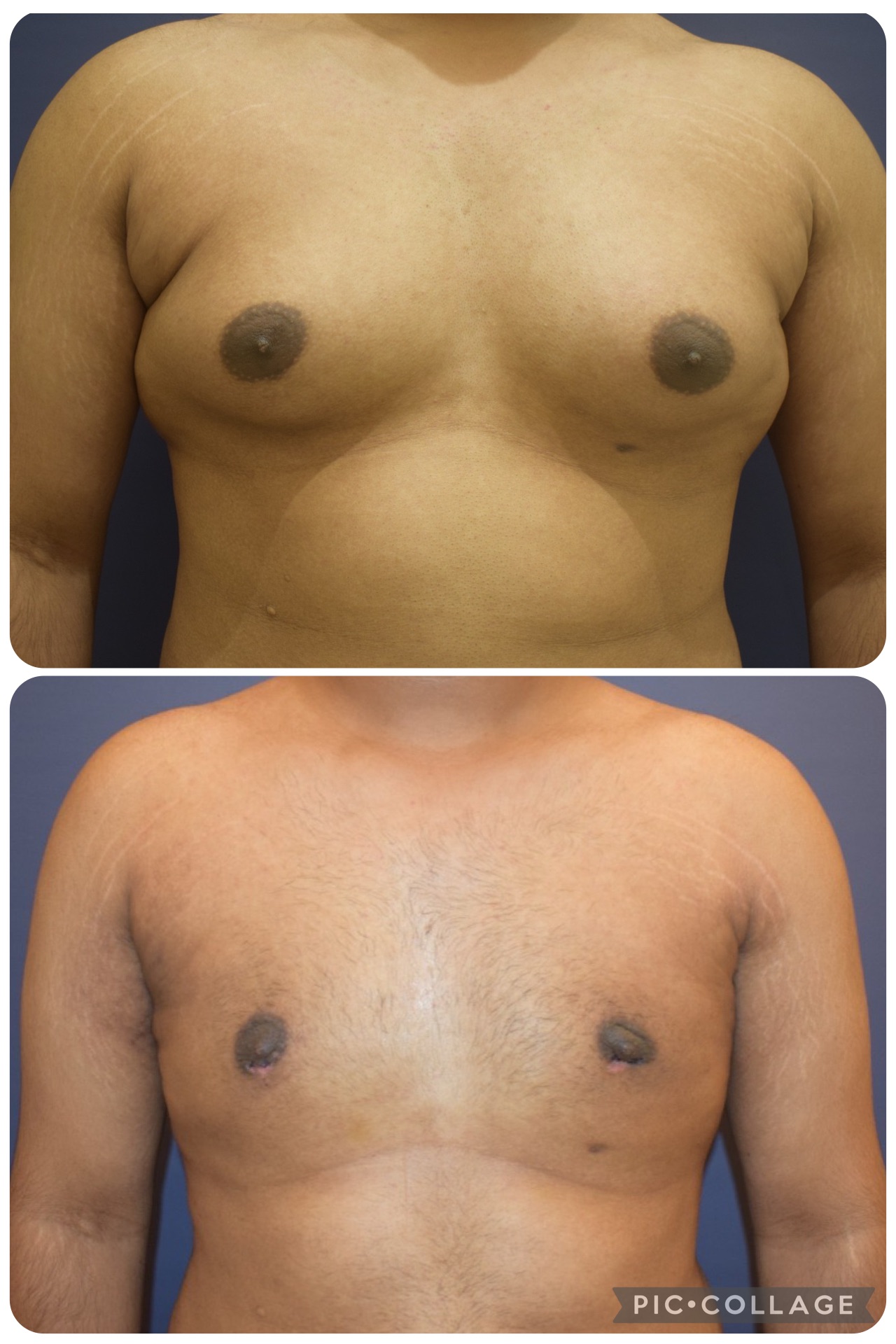 Results of grade 3 Gynecomastia with no loose skin in post operative