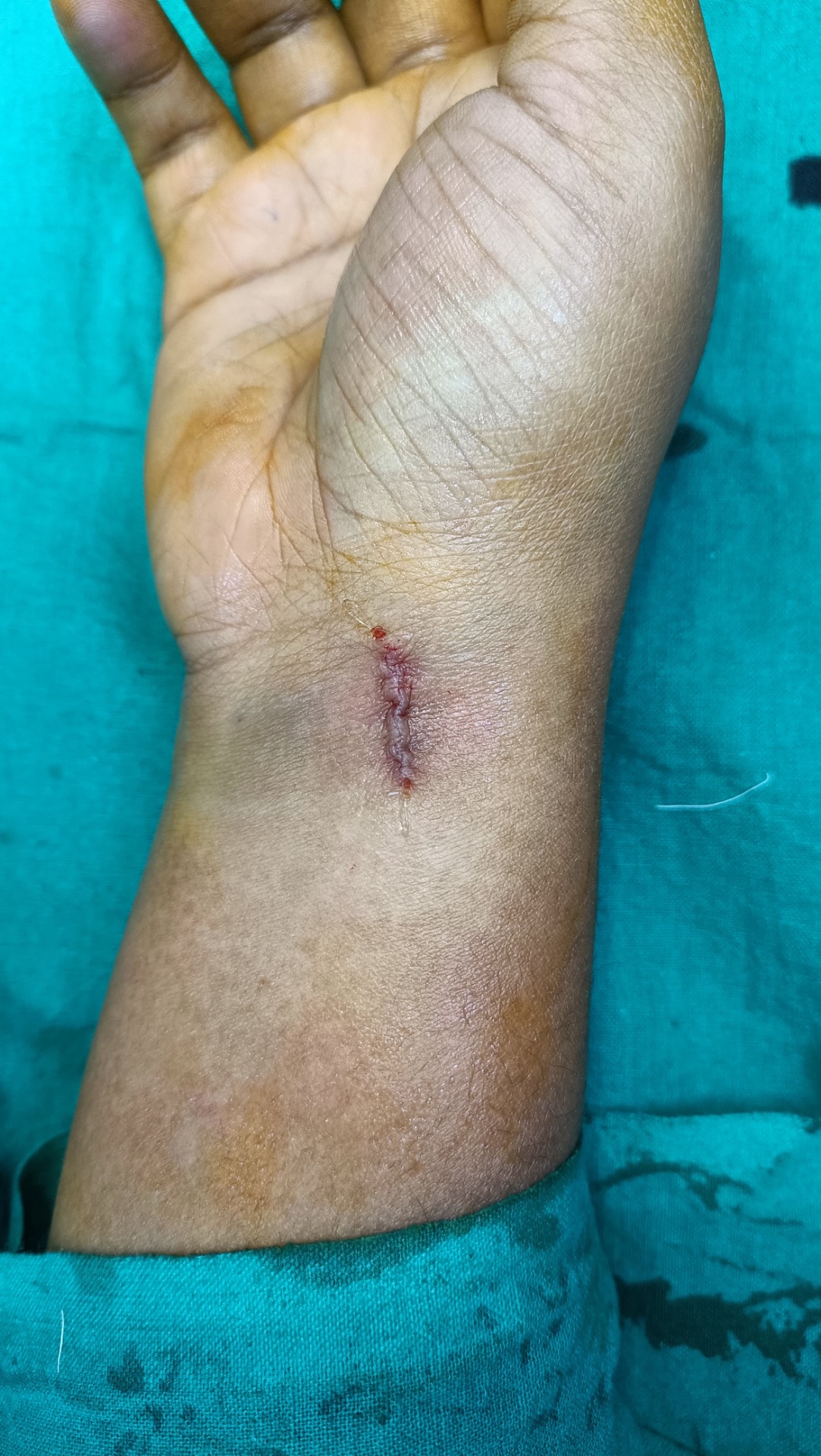 Good aesthetic outcome 