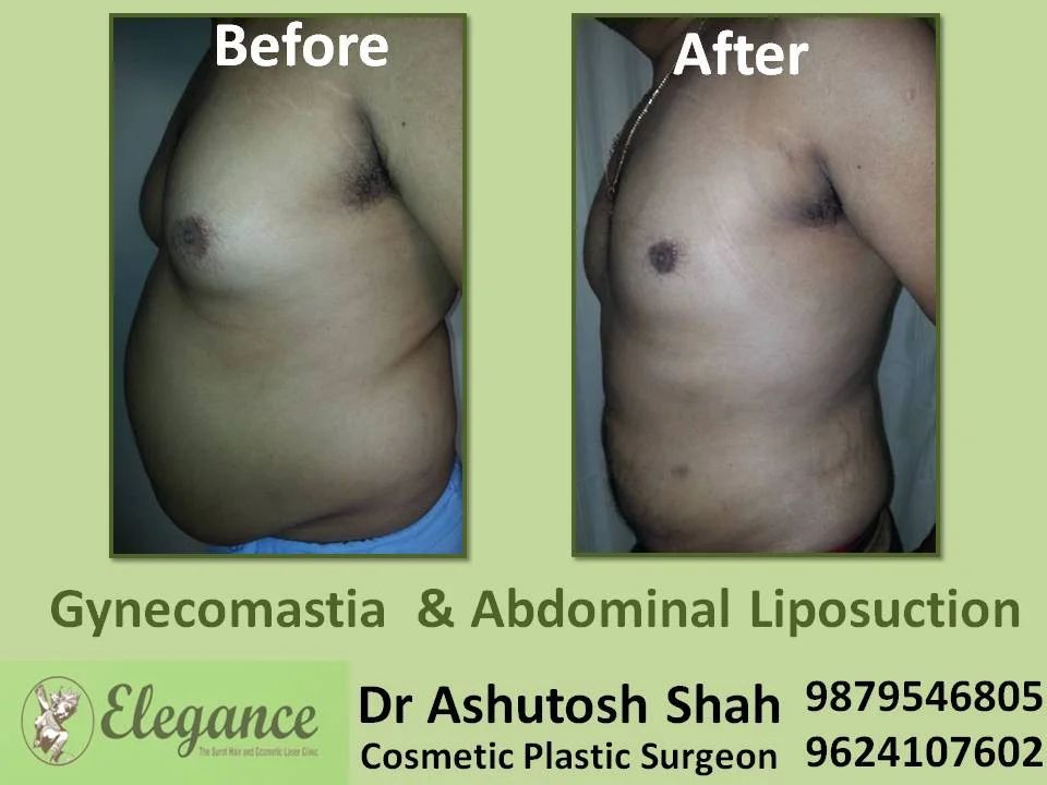 abdominal liposuction in young male