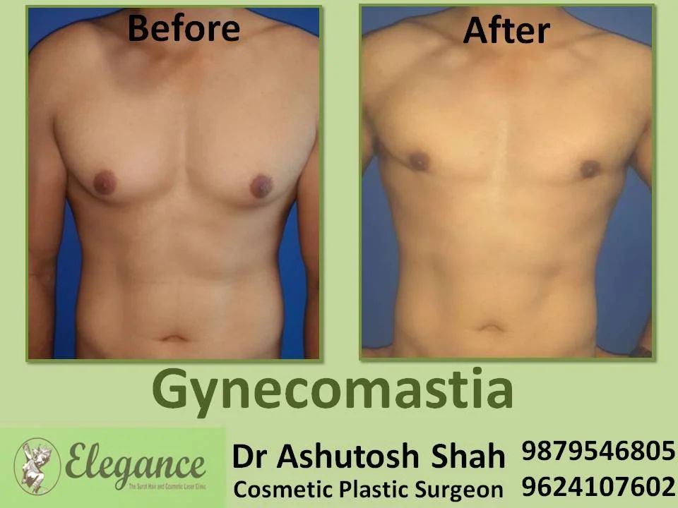 Grade 3 gynecomastia result after 3 months