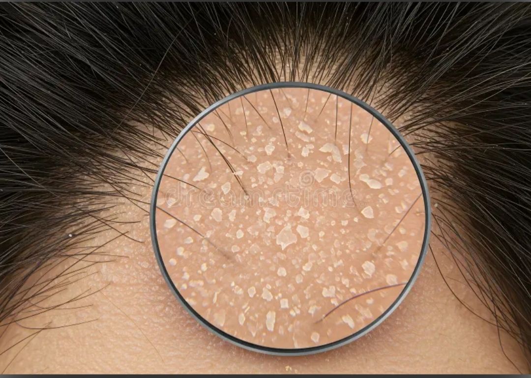 Dandruff Causes and Treatment