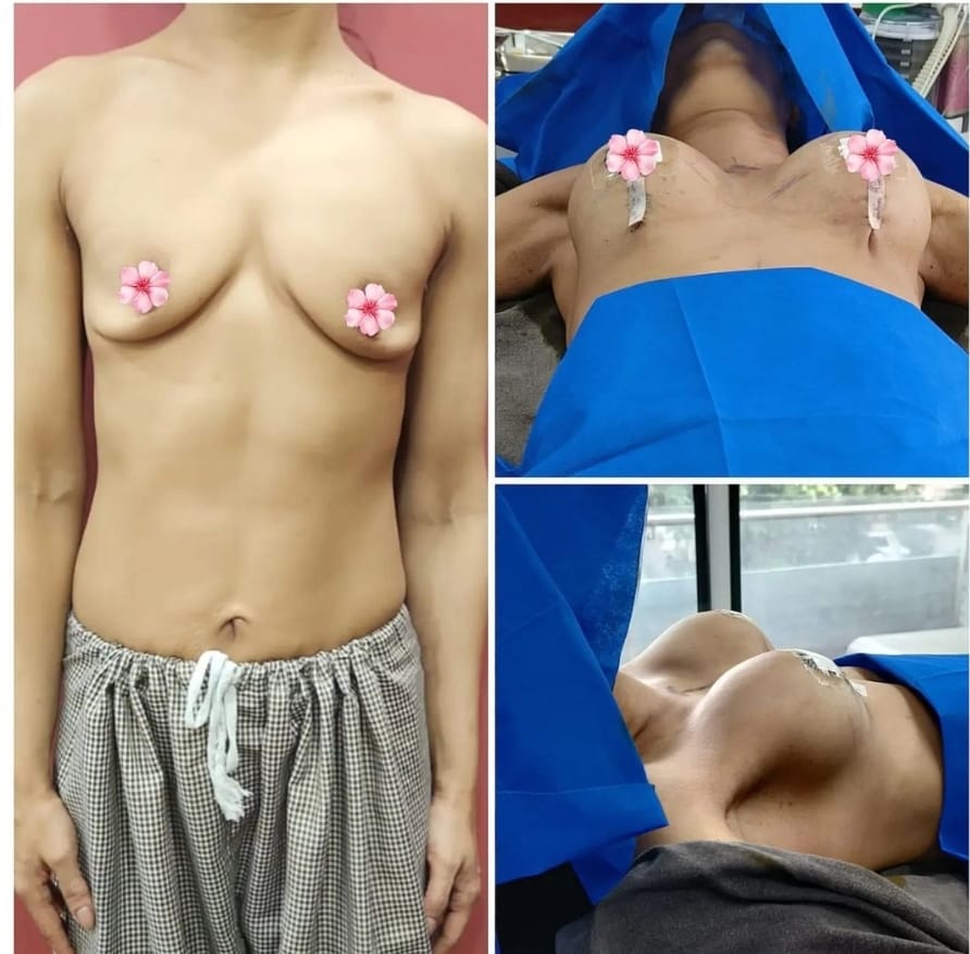 on table results of breast lift and implant