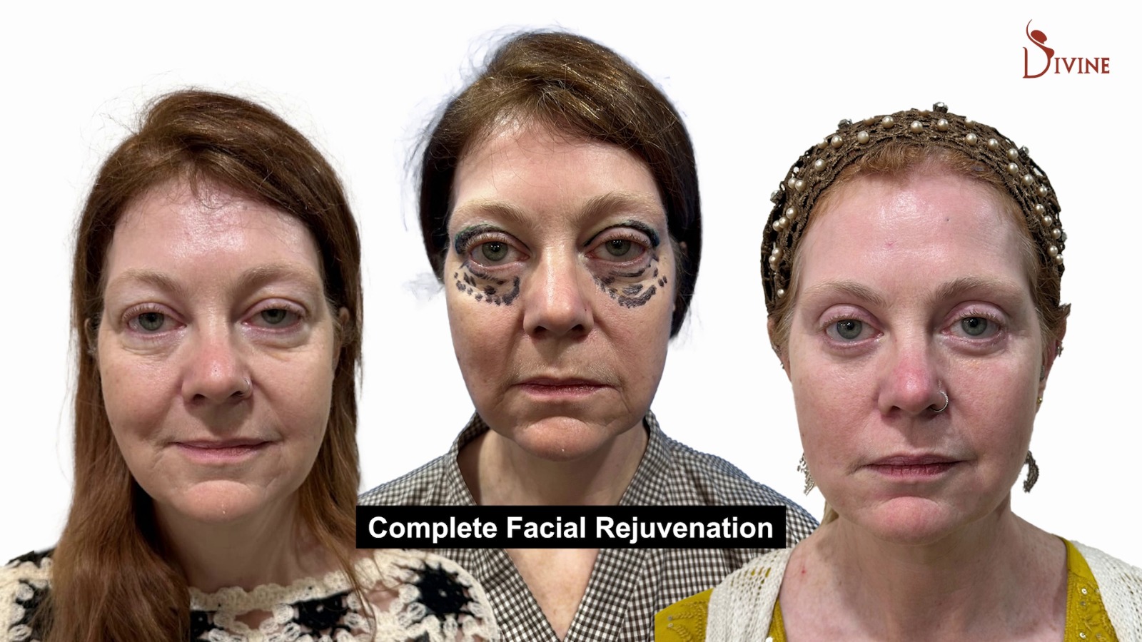 bfore and after of an australian patient with 8 face threads