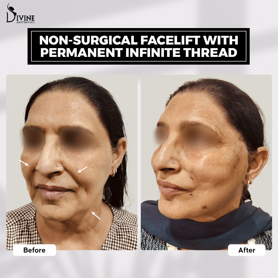 before after. 8 threads on the face of a 60 year old lady