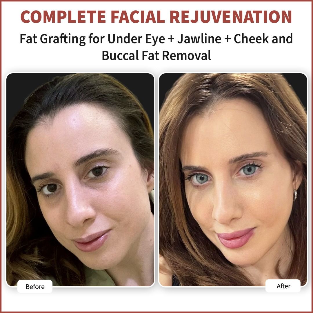 Facial Fat Grafting Results