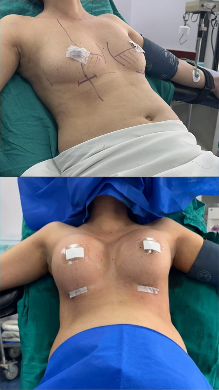 before after image to show the better cleavage and upper pole