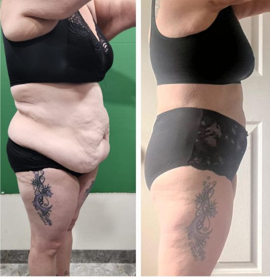 Weight Loss and Tummy Tuck Surgery