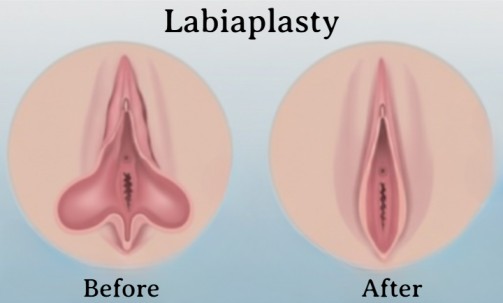 results of labiaplasty