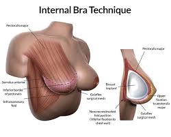 internal bra technique