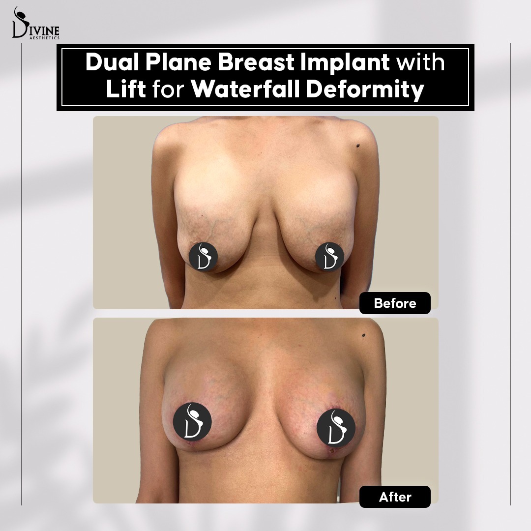 repair of a previously botched breast lift by Aeona Prime breast lift technique