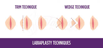 Labiaplasty Options Results