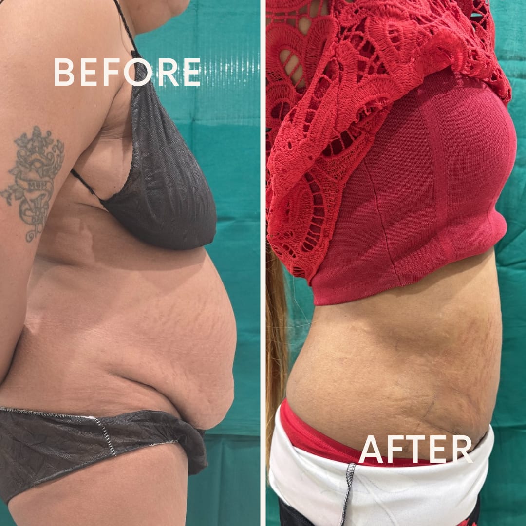 Tummy Tuck After Pregnancy