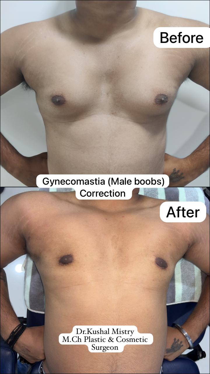 Gynecomastia ( male boobs) correction 