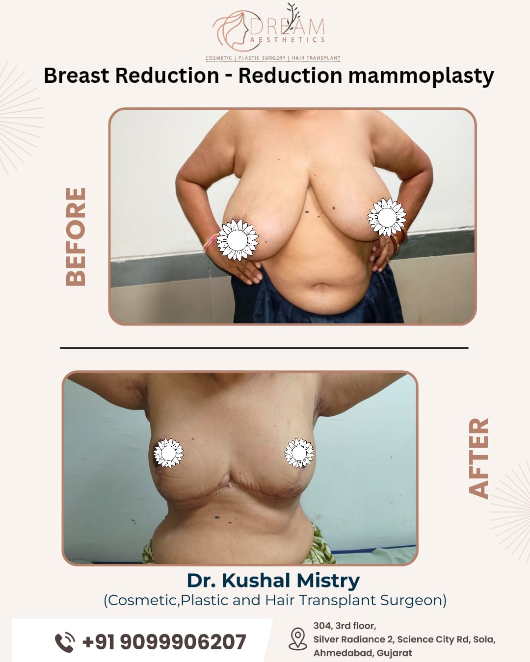 Breast reduction 