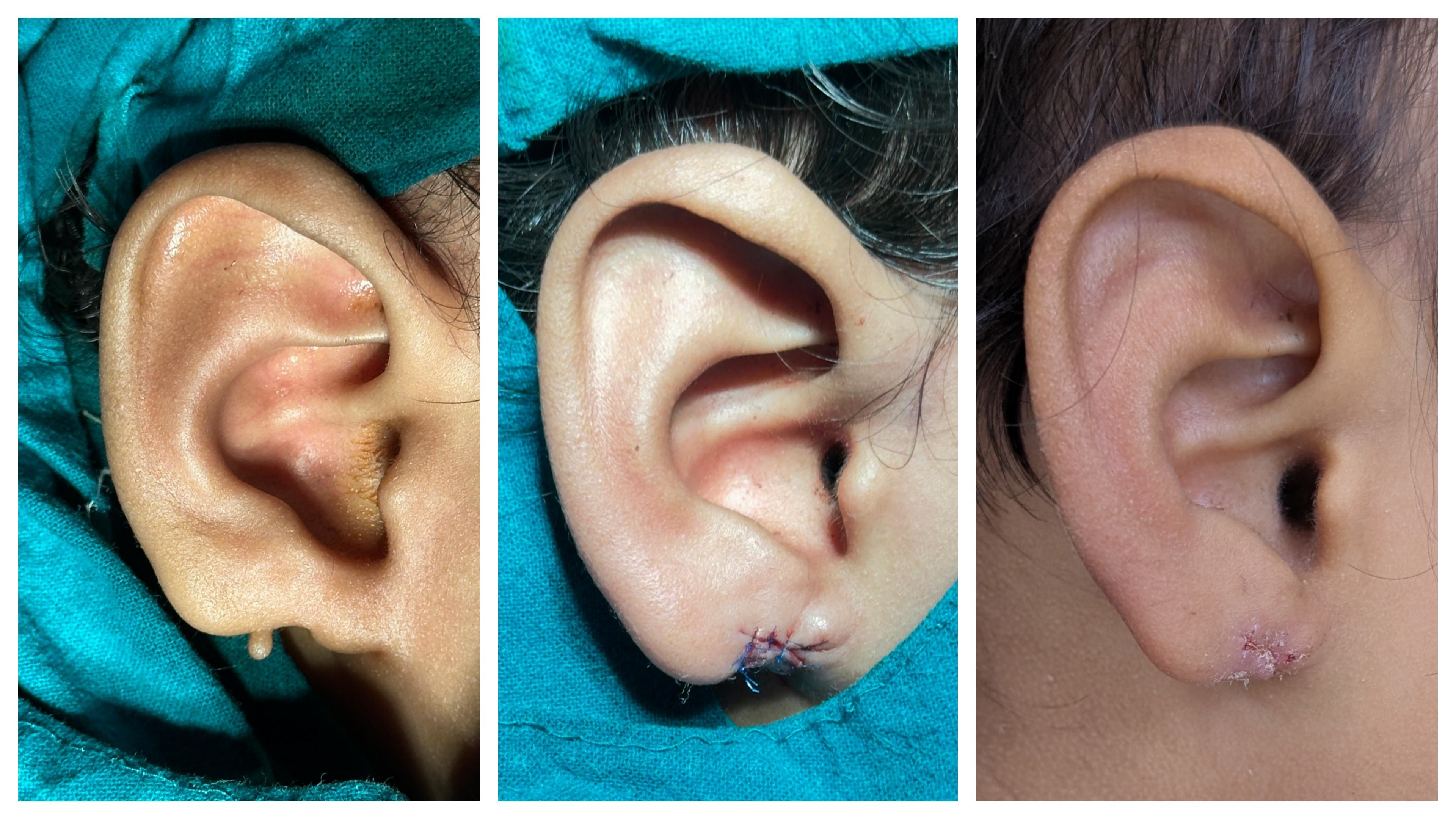 Congenital Ear Defects