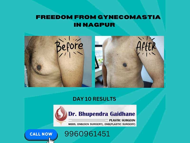 Chest reshaping done with ultrasonic energy to improve contour and reduce bulk.