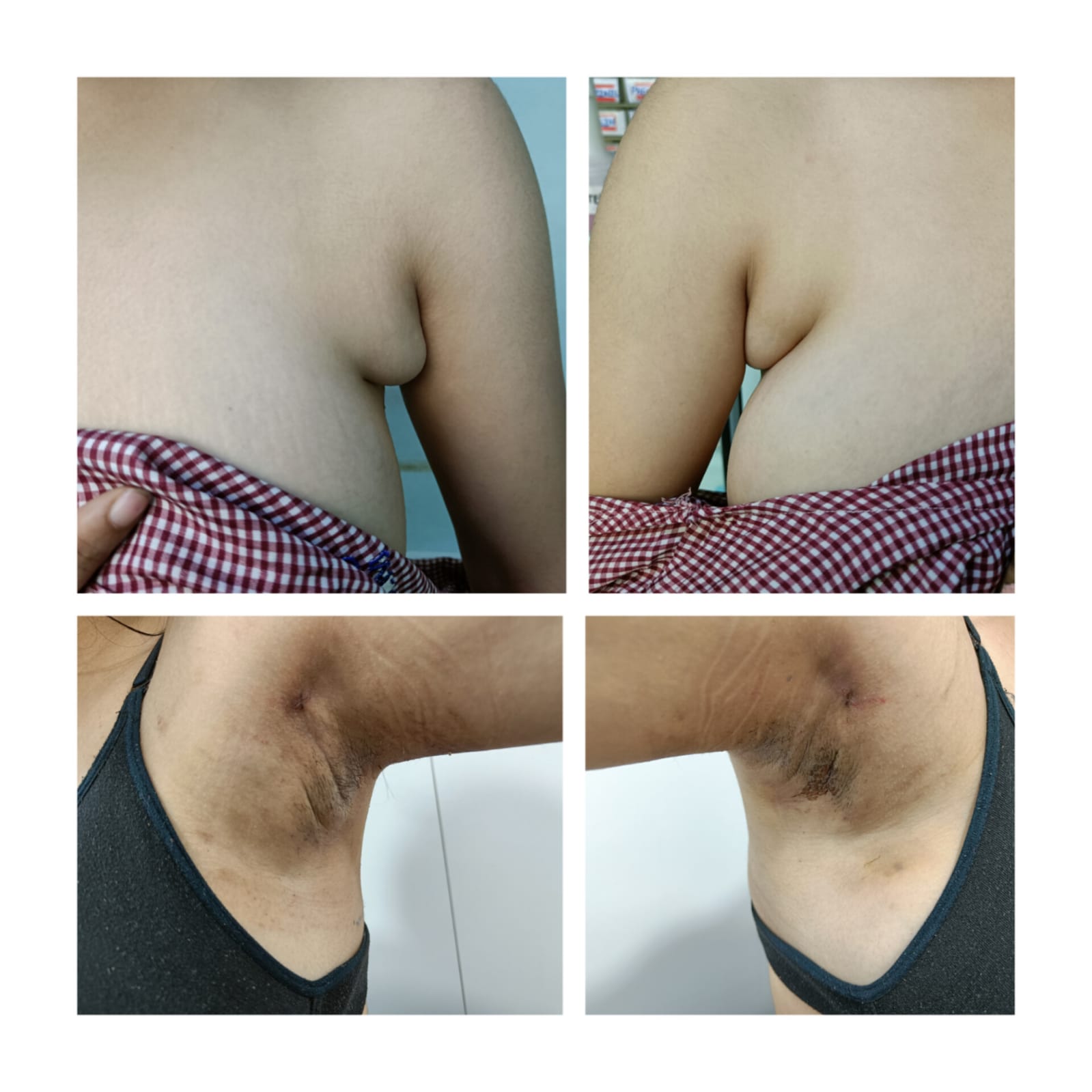 Before and after images of axillary breast reduction by liposuction in Nagpur.