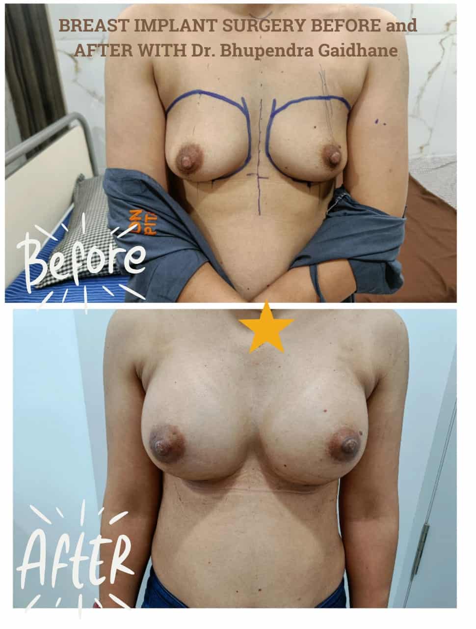 Before and after results of breast implant surgery performed by Dr. Bhupendra Gaidhane in Nagpur.