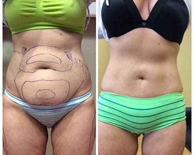 Belly fat before and after liposuction results, showcasing fat removal and maintained flat stomach.