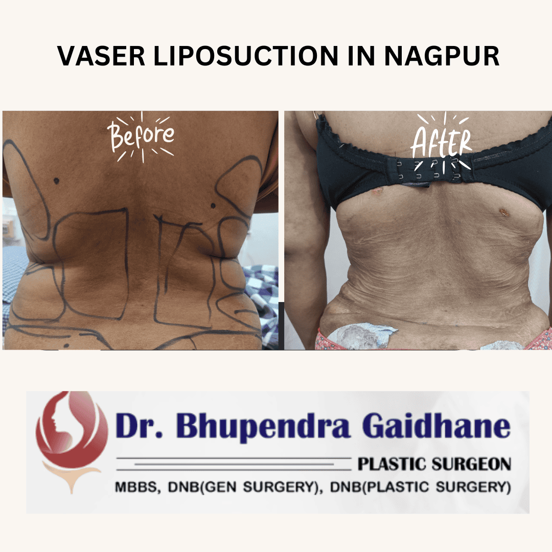 Before and after results of VASER liposuction performed by Dr. Bhupendra Gaidhane in Nagpur.